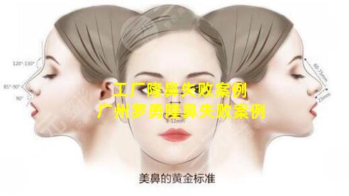 工厂隆鼻失败案例 广州罗勇隆鼻失败案例